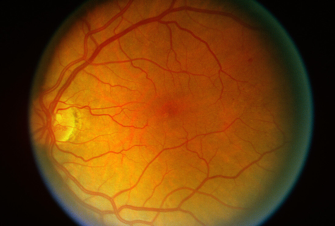 Diabetic Retinopathy