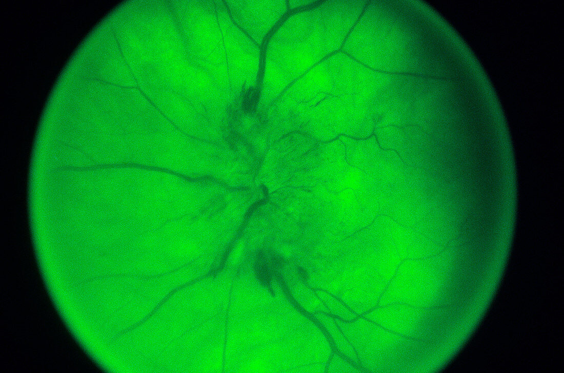 Papilloedema of the Eye