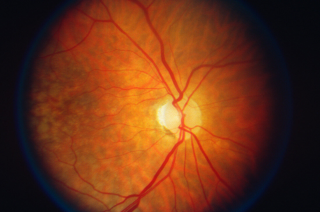 Chiasmal Syndrome Retina