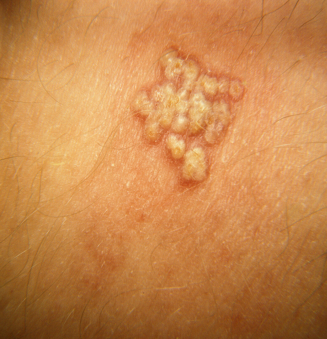 Herpes Simplex Blisters on Thigh