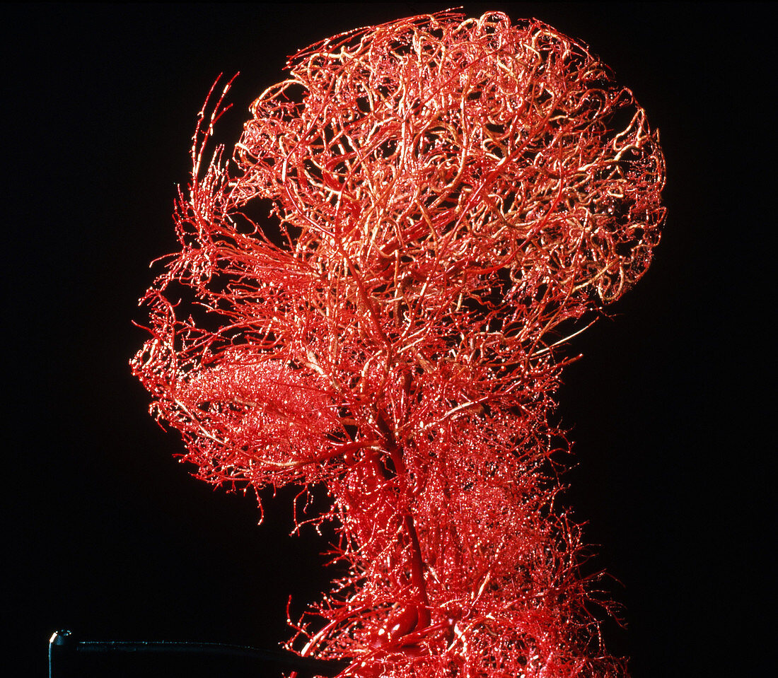 Blood vessel cast of stillborn's head