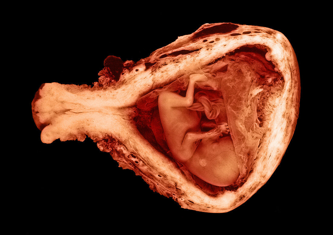 13 week old human fetus
