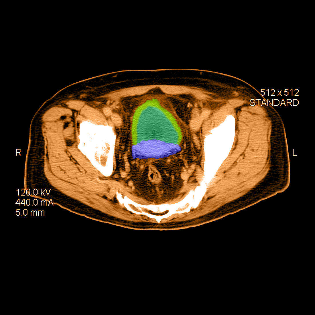 CT of Prostate Cancer