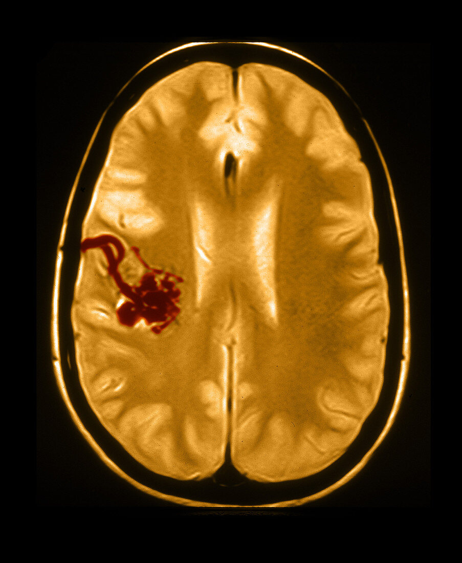 MRI of Arterial Venous Malformation