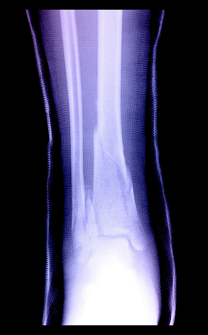 Leg Fractures with Cast