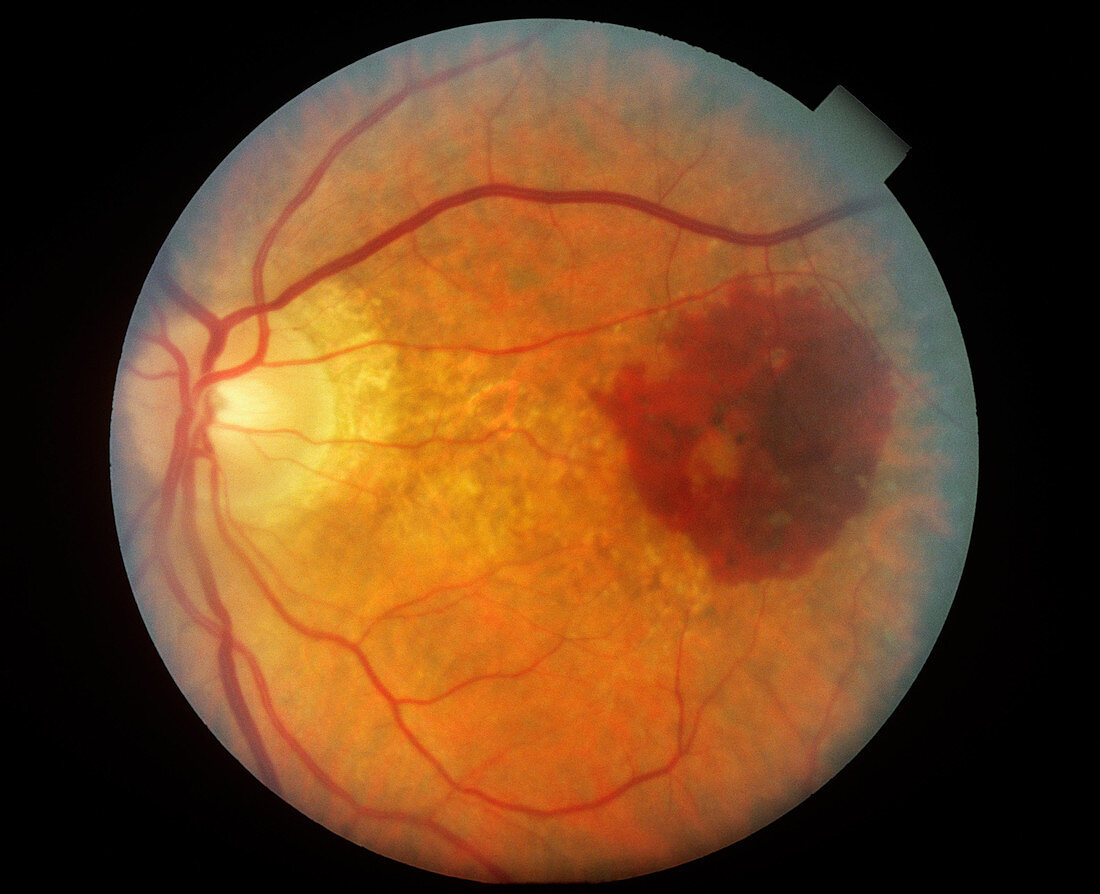 Retinal Hemorrhage (1 of 3)