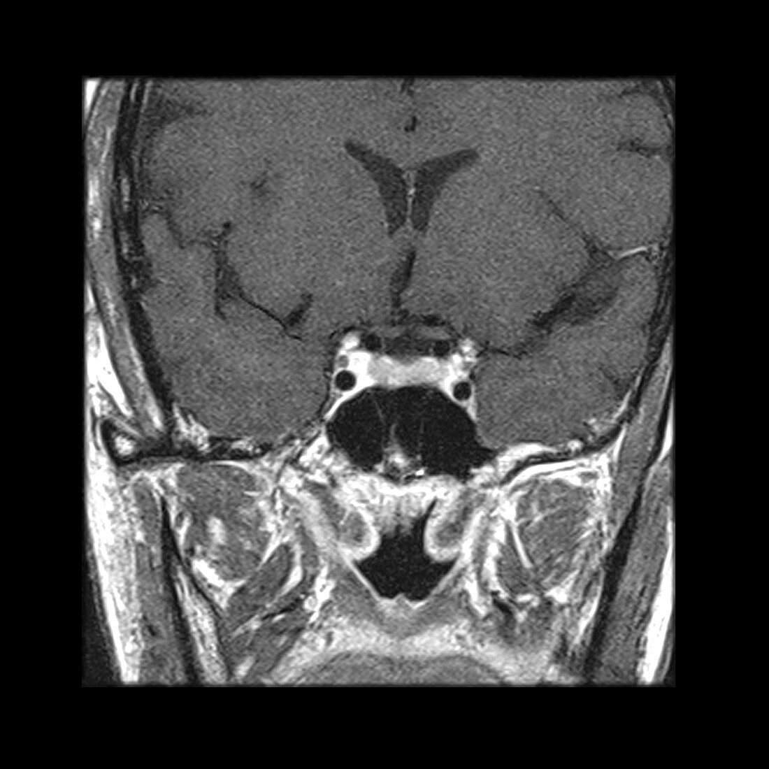 'Oculomotor Nerve in Cavernous Sinus,MRI