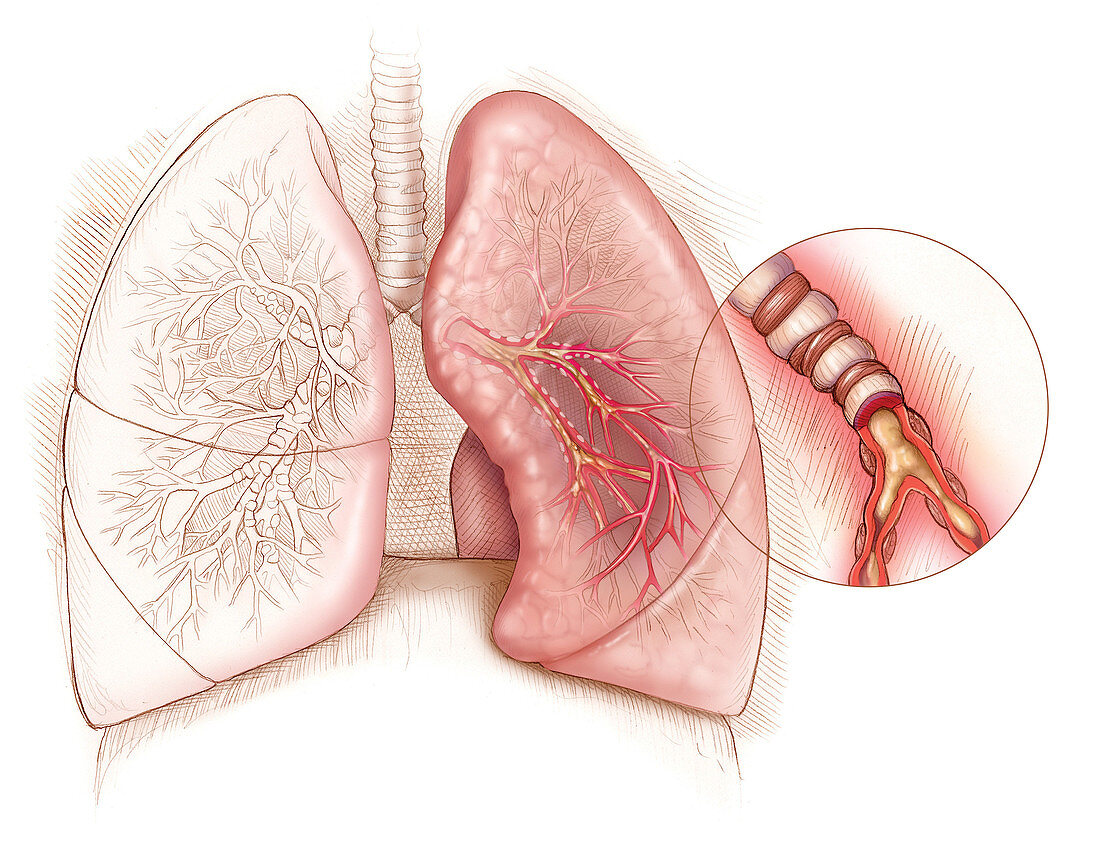 Illustrating Asthma