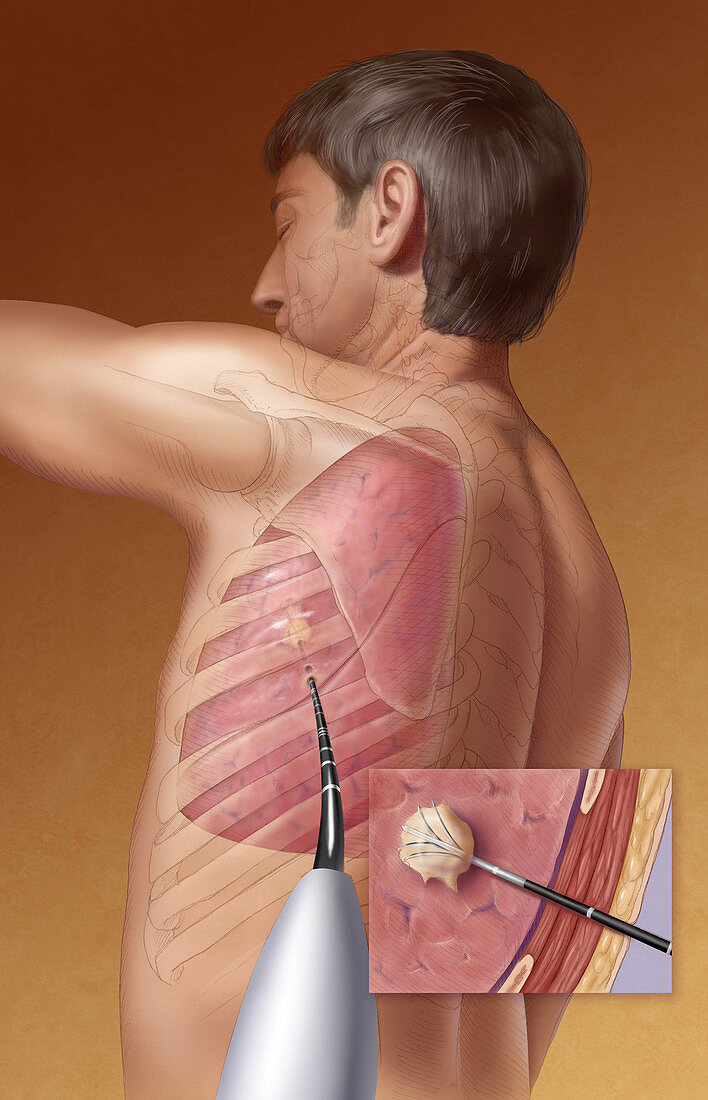 Radiofrequency Ablation of Lung Tumor