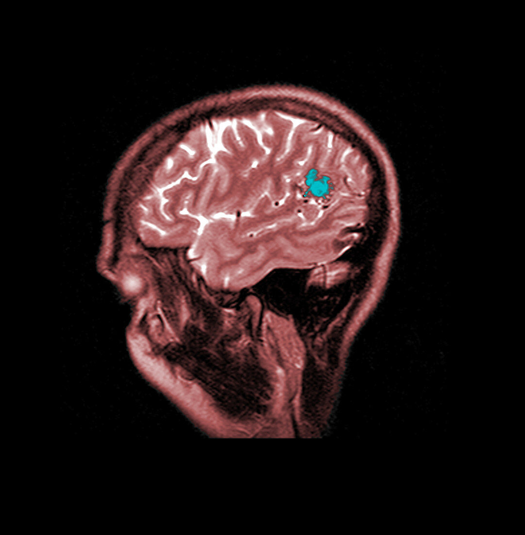 MRI of Brain AVM