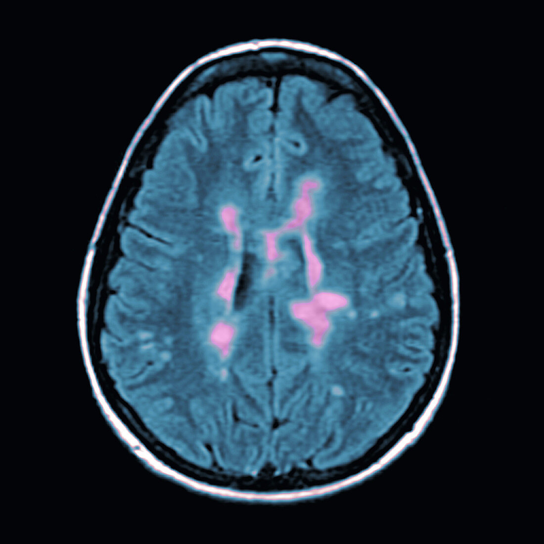 MRI of Multiple Sclerosis