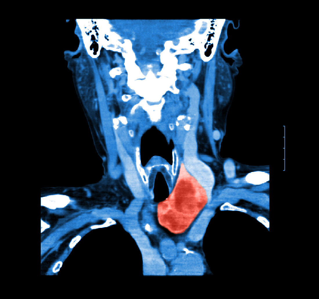 CT of neck showing thyroid goiter