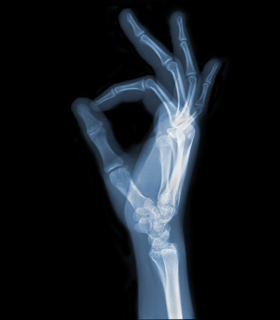 'Hand,X-Ray'
