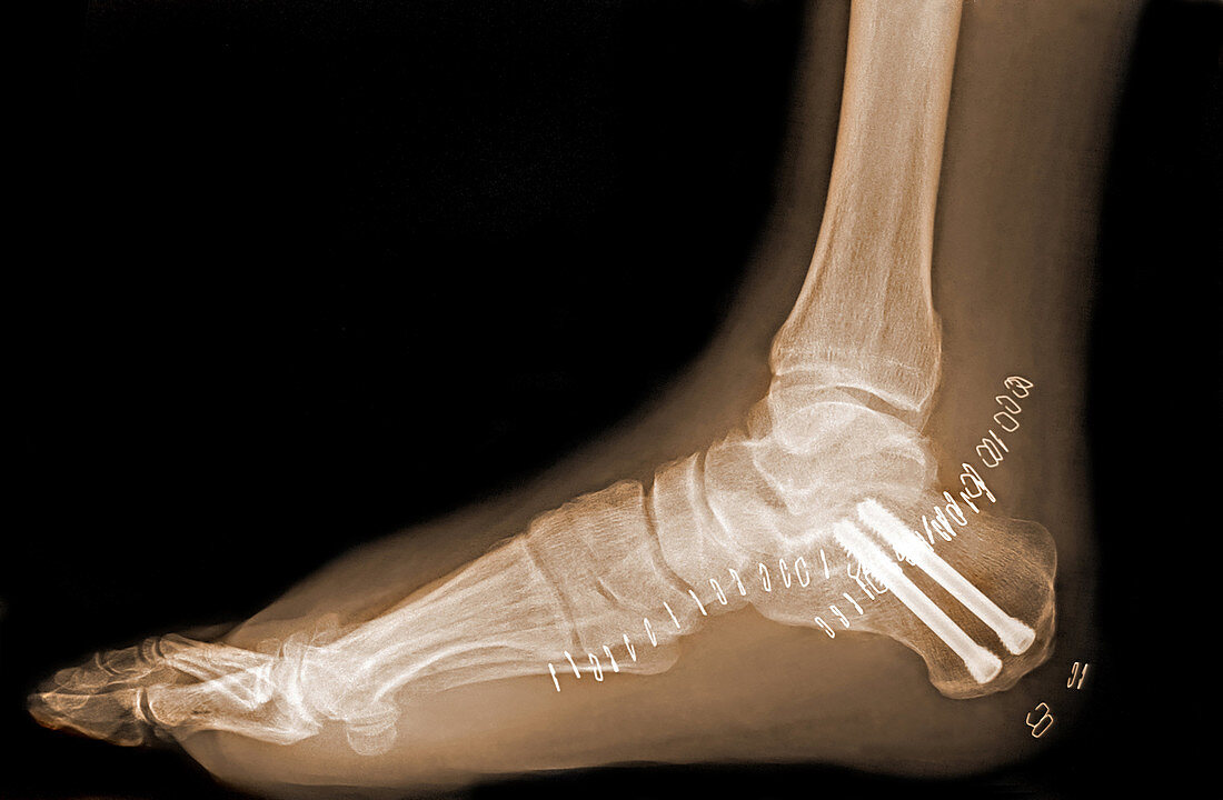 'Fractured Ankle,X-Ray'