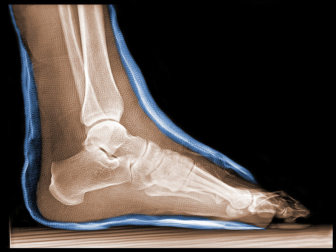'Broken Ankle in Cast,X-Ray'