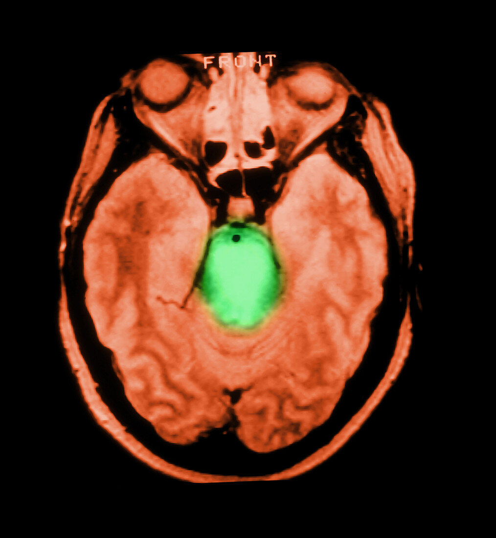 MRI of Brainstem Glioma