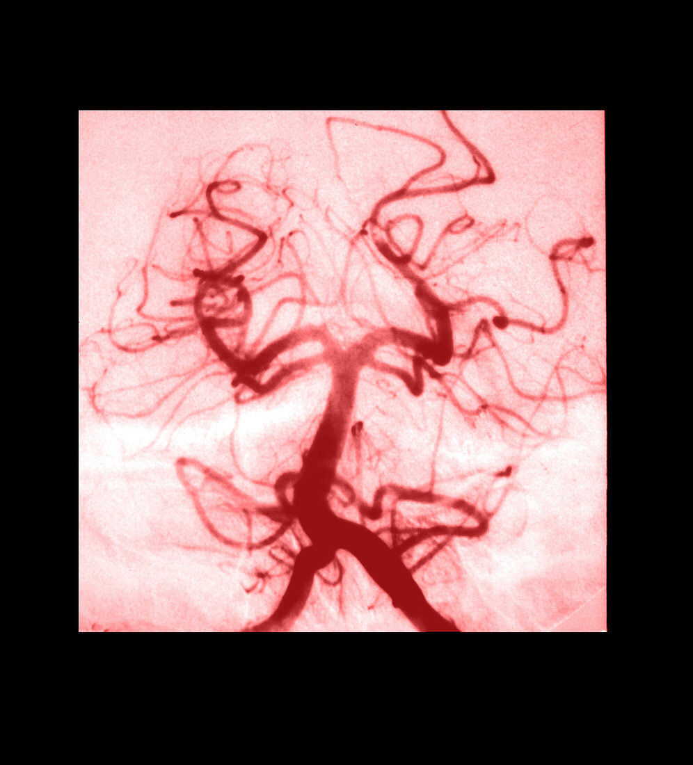 Angiogram of Embolus in Cerebral Artery