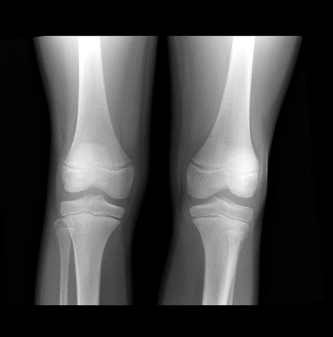 'Normal Pediatric Legs/Knees,X-Ray'