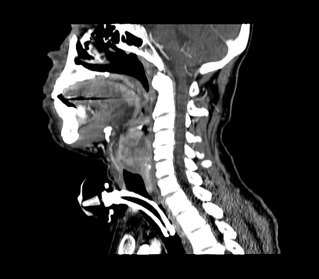 Laryngeal Cancer & Tracheostomy Tube