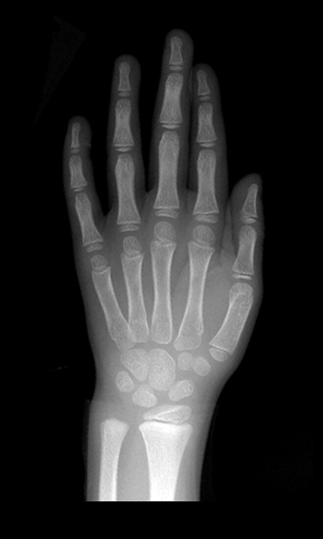 Normal Pediatric Hand X-Ray