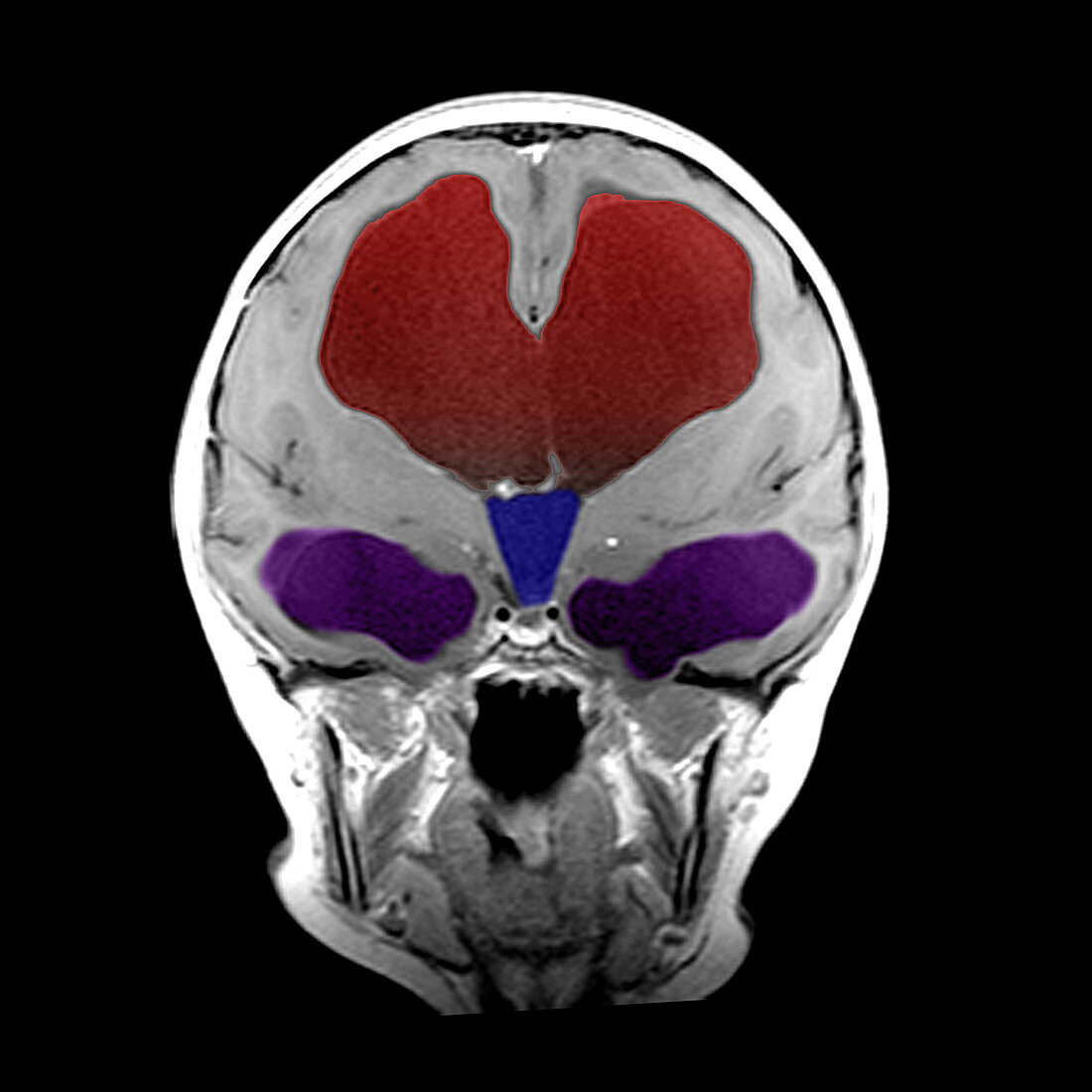 Hydrocephalus of Third Ventricle