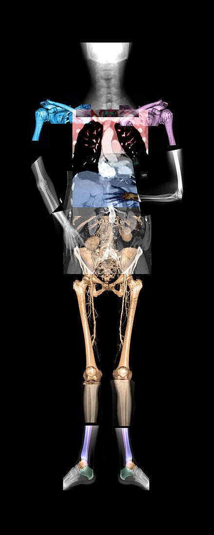 Whole Body Composite Imaging