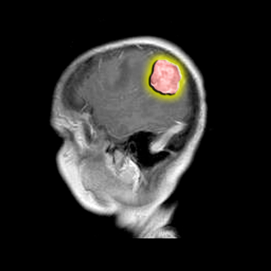 MRI of Metastatic Brain Lesion
