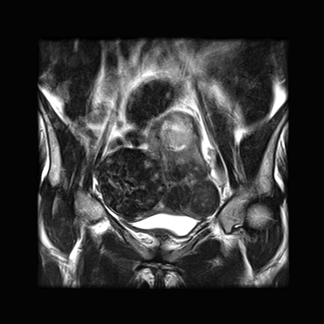 'Uterine Fibroids,MRI'