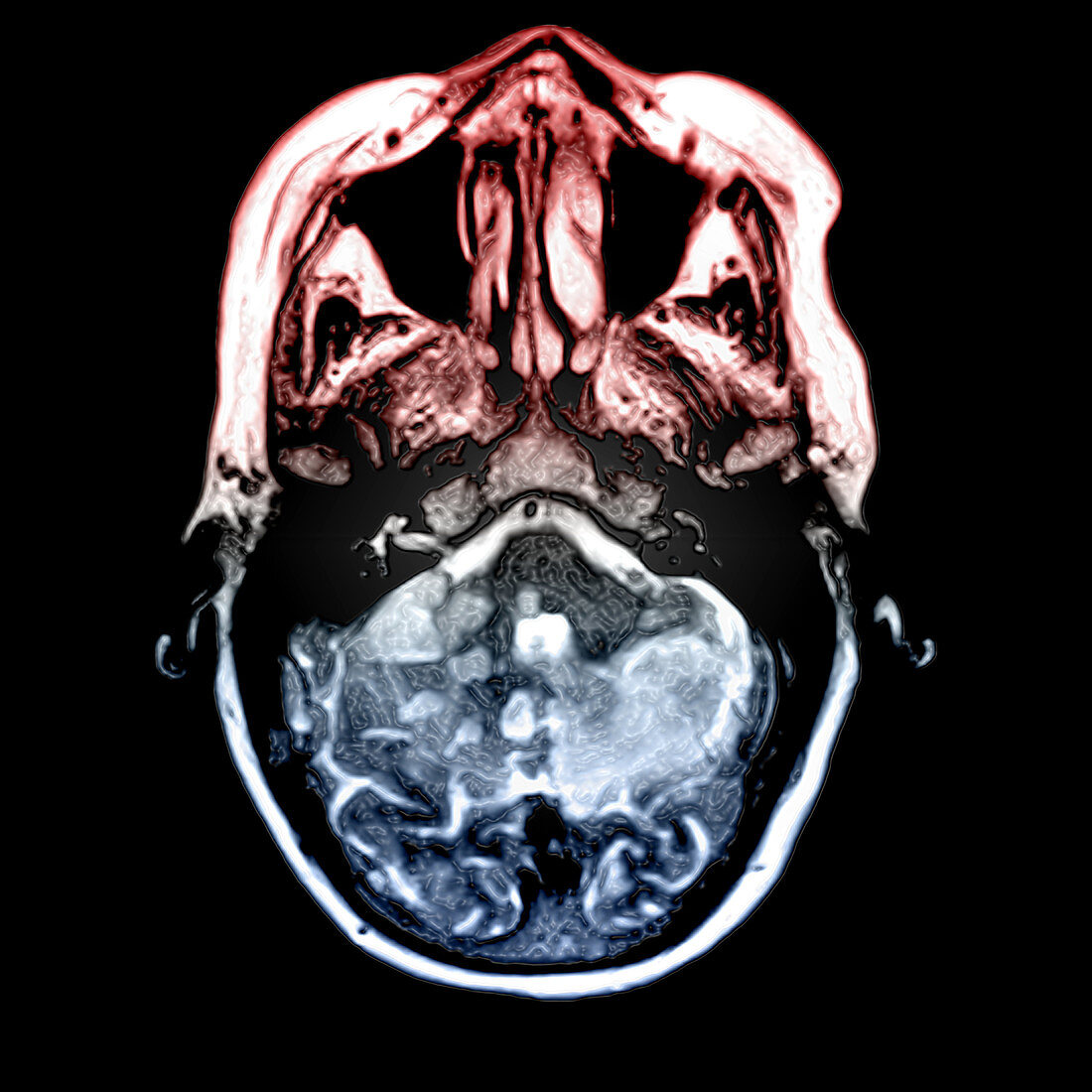 Cerebellar Infarcts on MRI