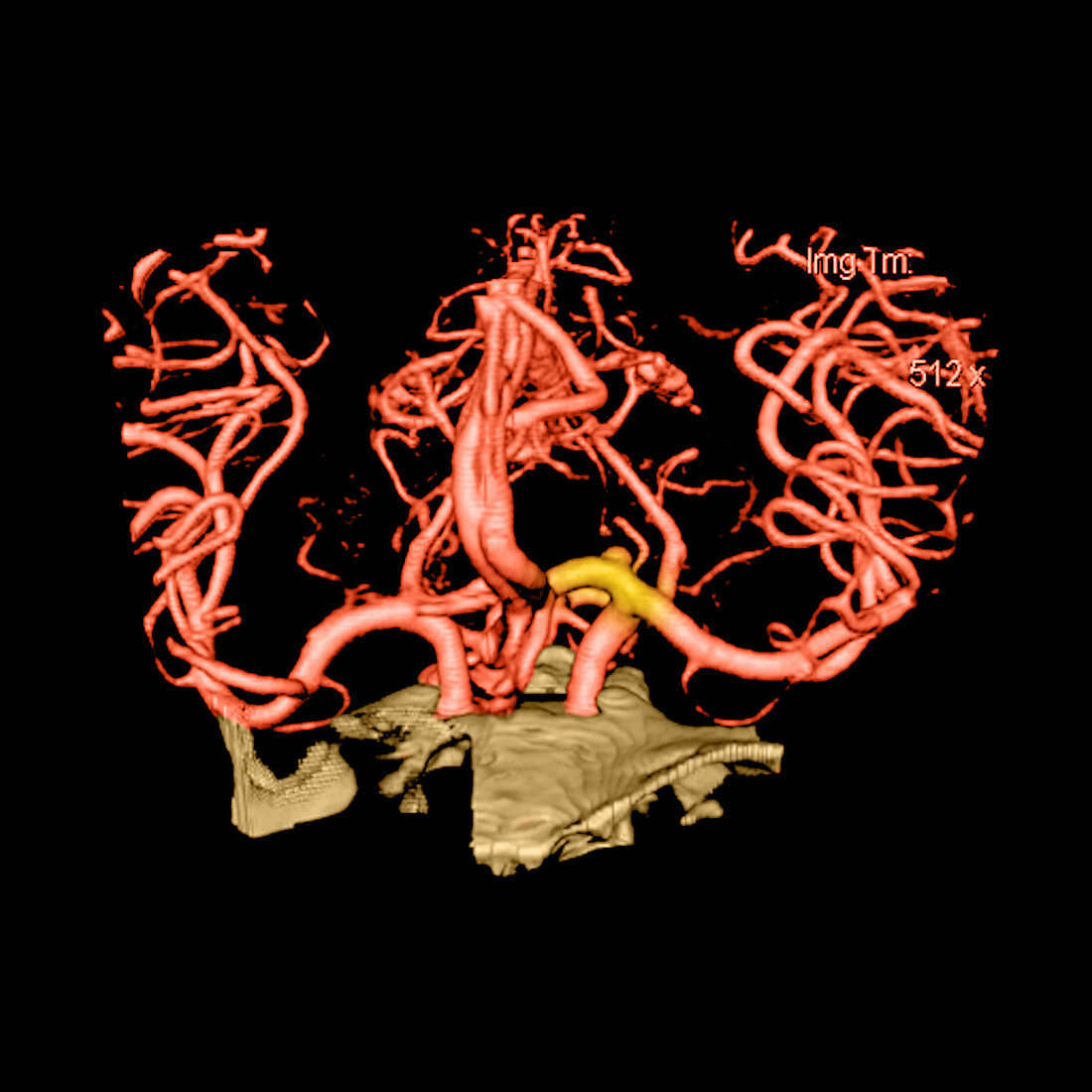 CT Angiogram of Aneurysm