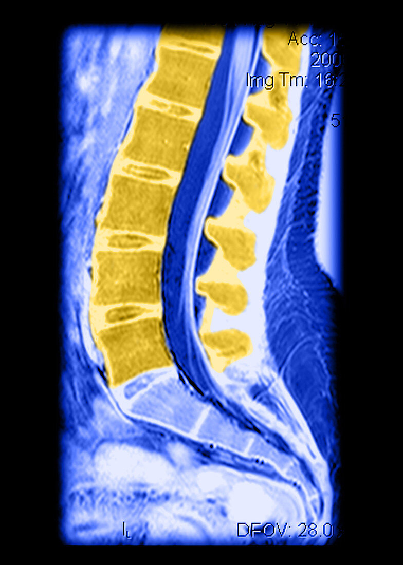 Normal Lumbar Spine