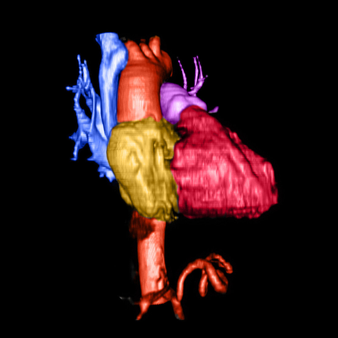 Color Enhanced 3D CTA of Heart