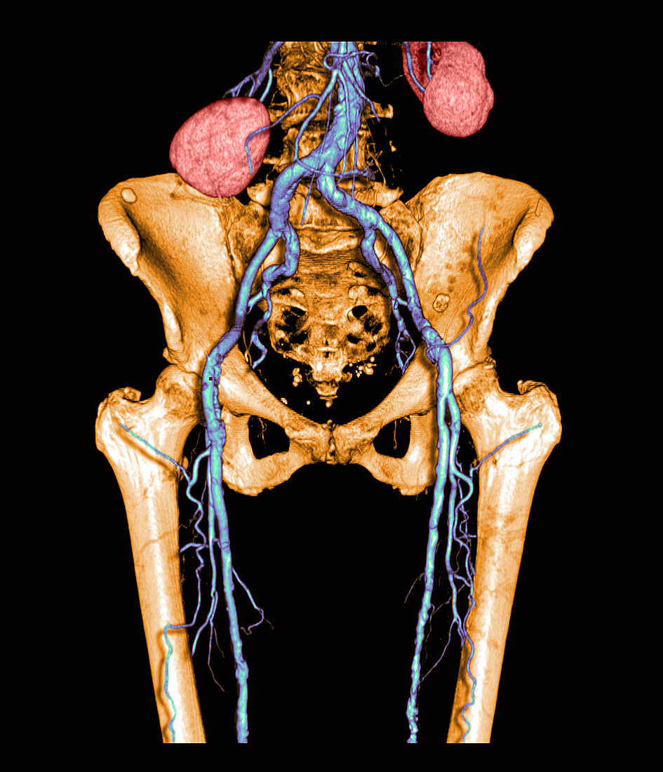 Pelvis and Upper legs with Arterioscleros