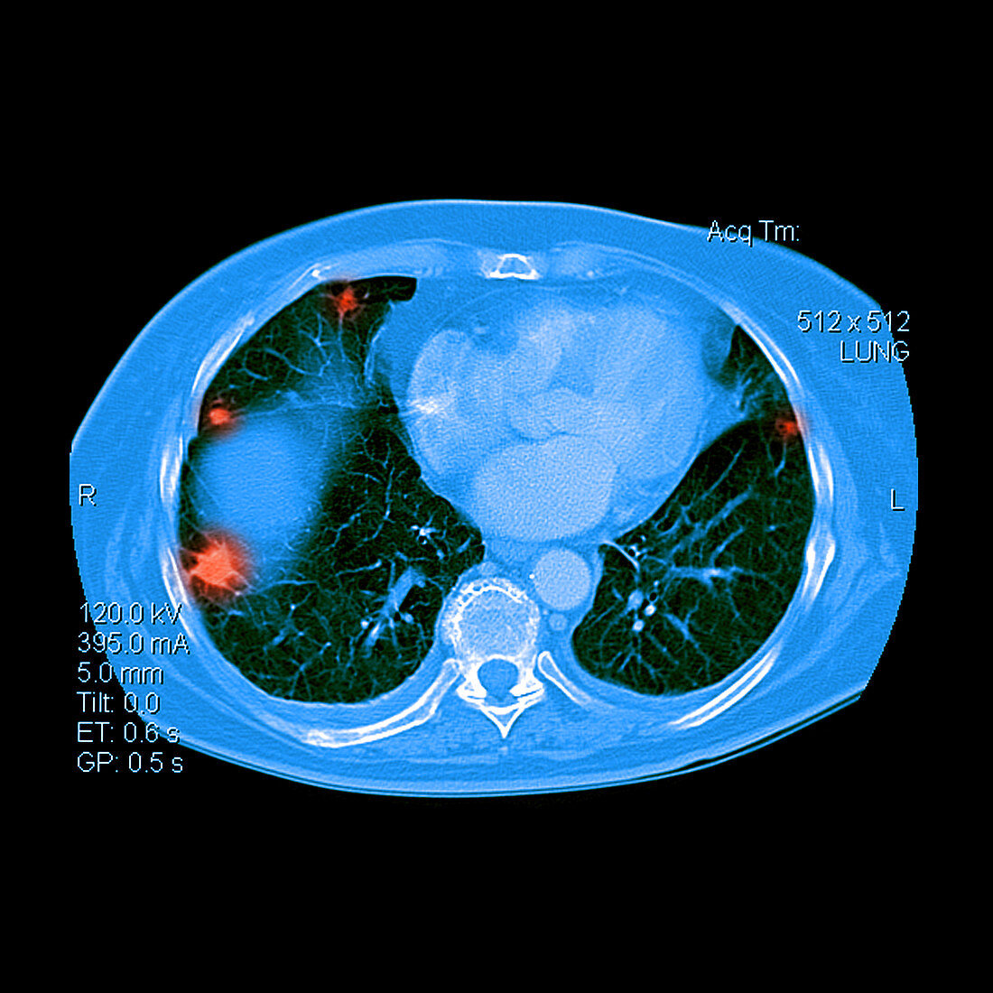 Metastatic Disease of the Lungs