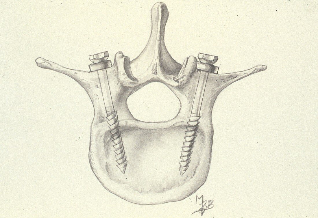 Fused Lumbar Vertebrae