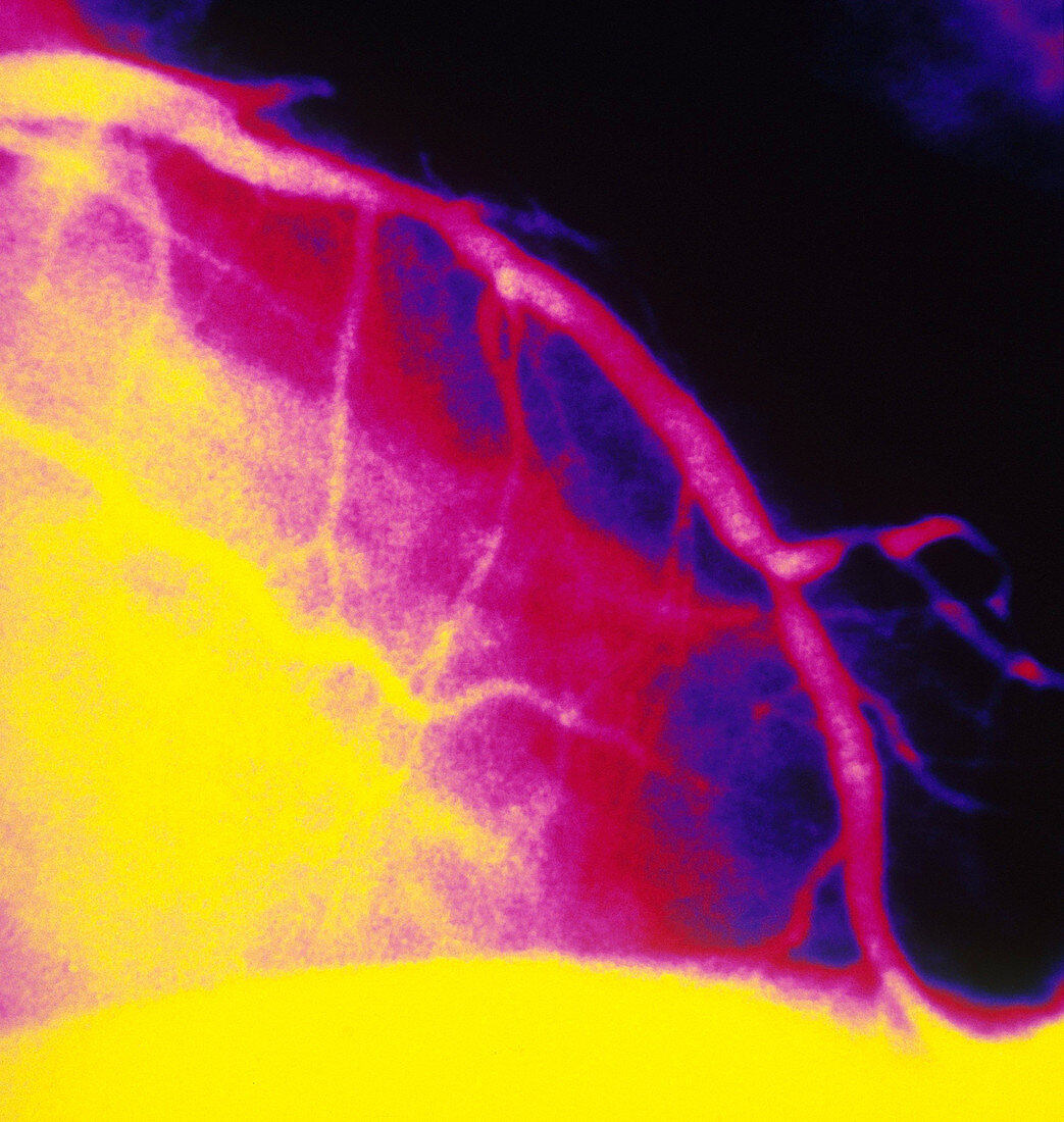 Narrowing in Coronary Artery (3 of 3)