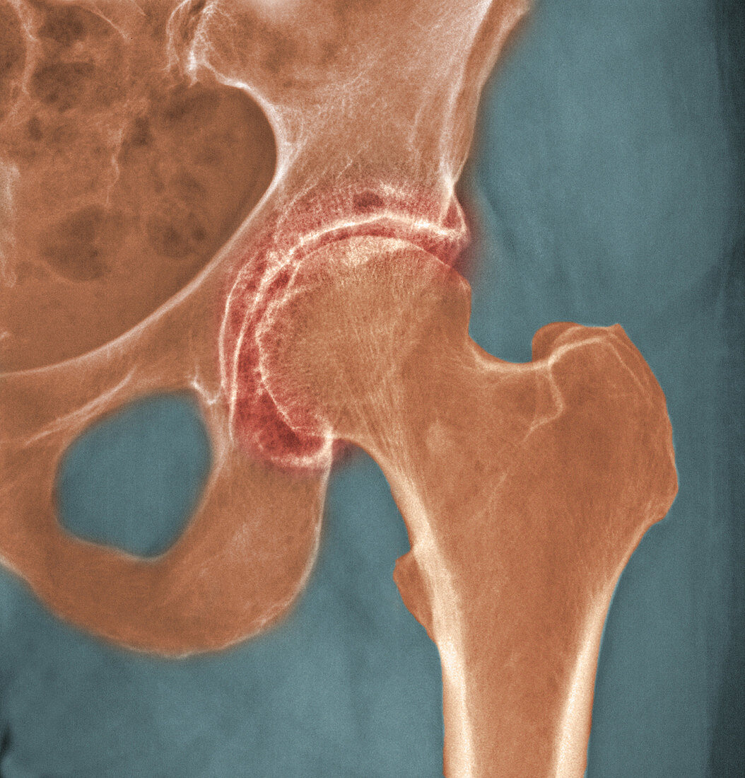 Osteoarthritis,Hip