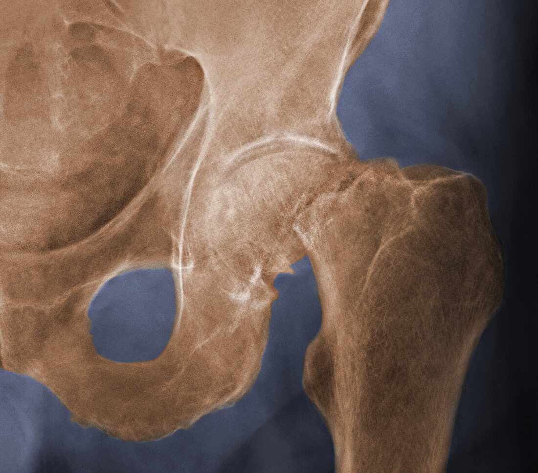 Hip Fracture,X-Ray