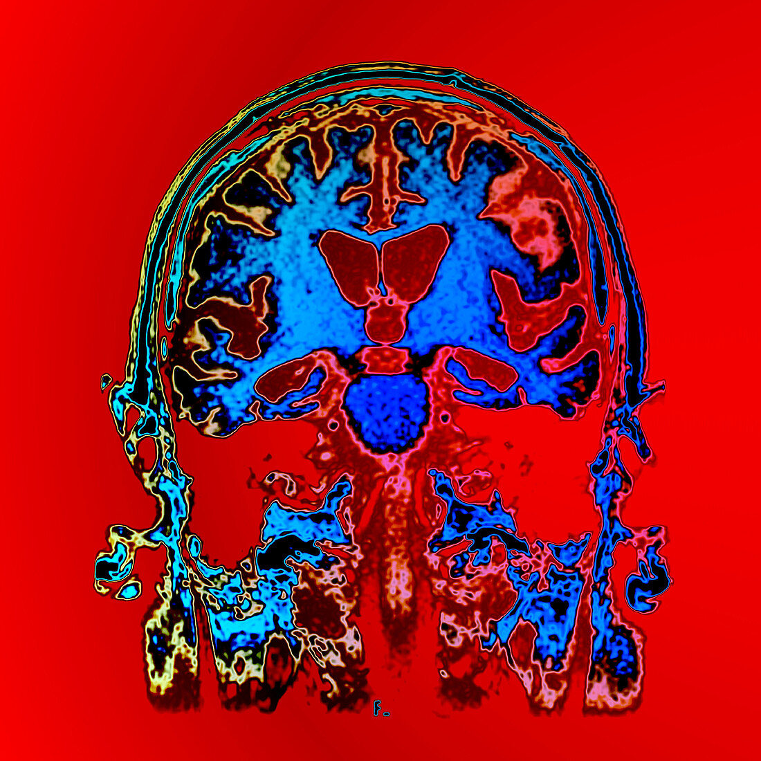 MRI of Alzheimers Disease 4 of 4
