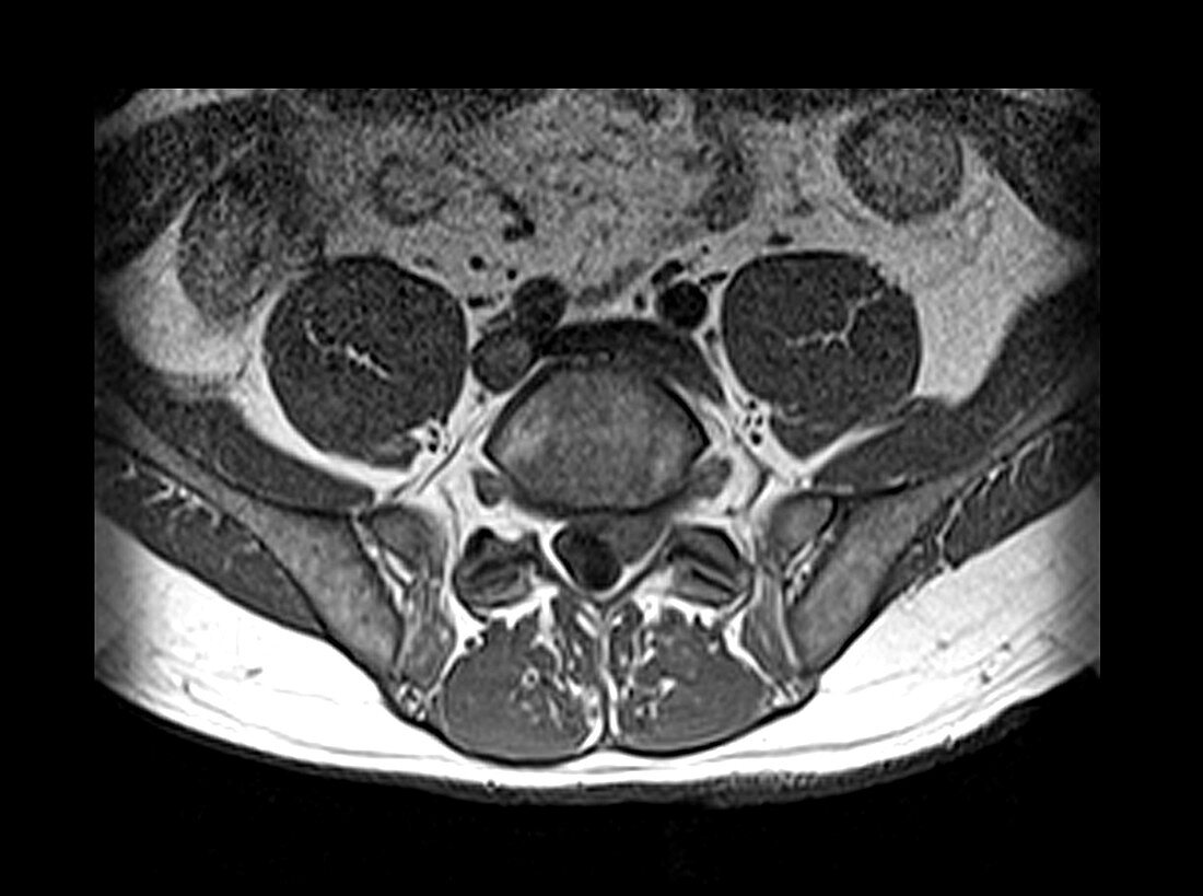 MRI of Lumbar Disc Herniation
