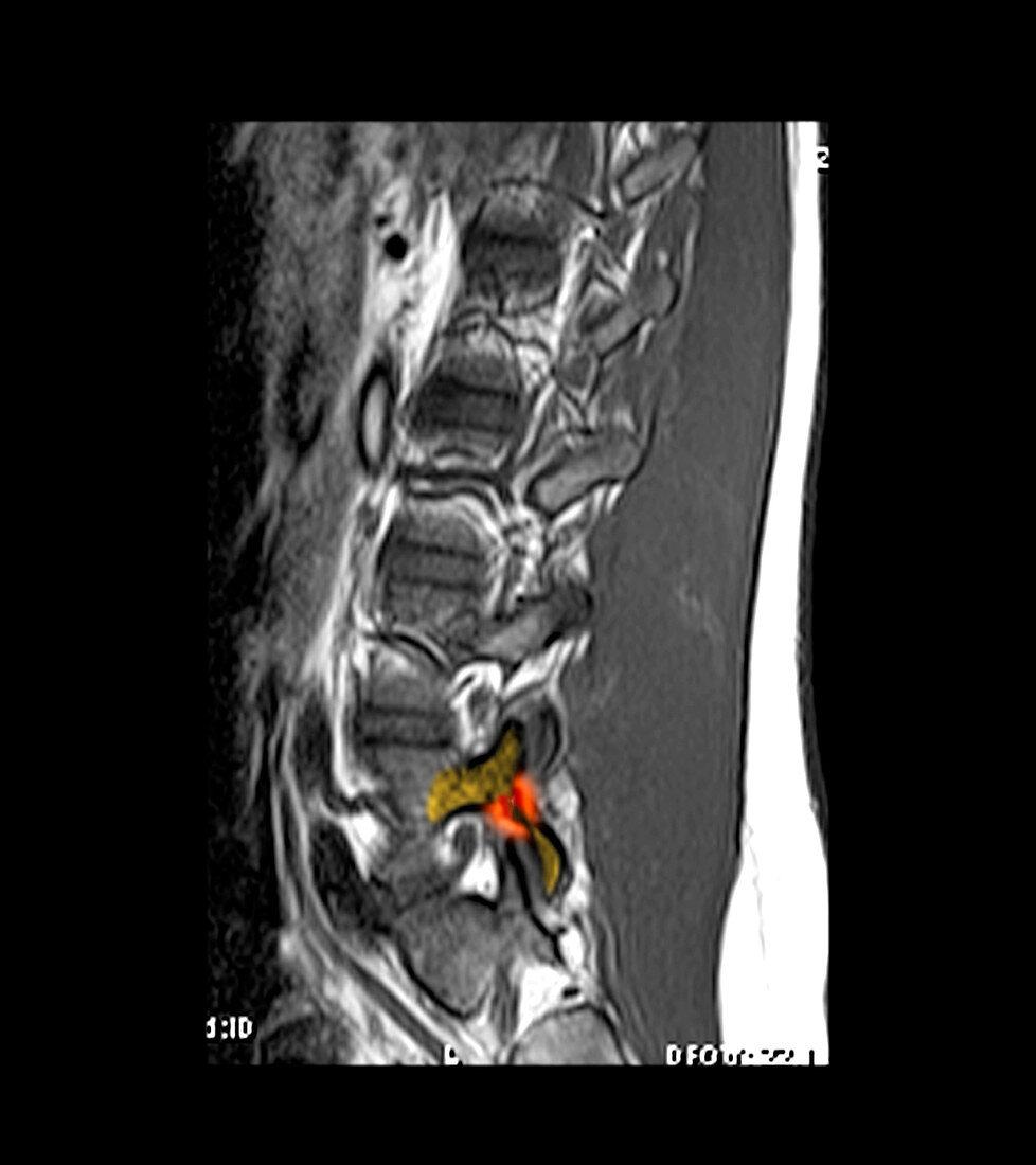 MRI of L5 Spondylolysis