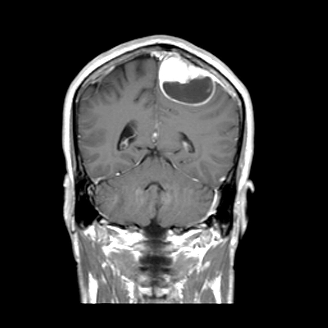 Cystic Meningioma,Contrast CT
