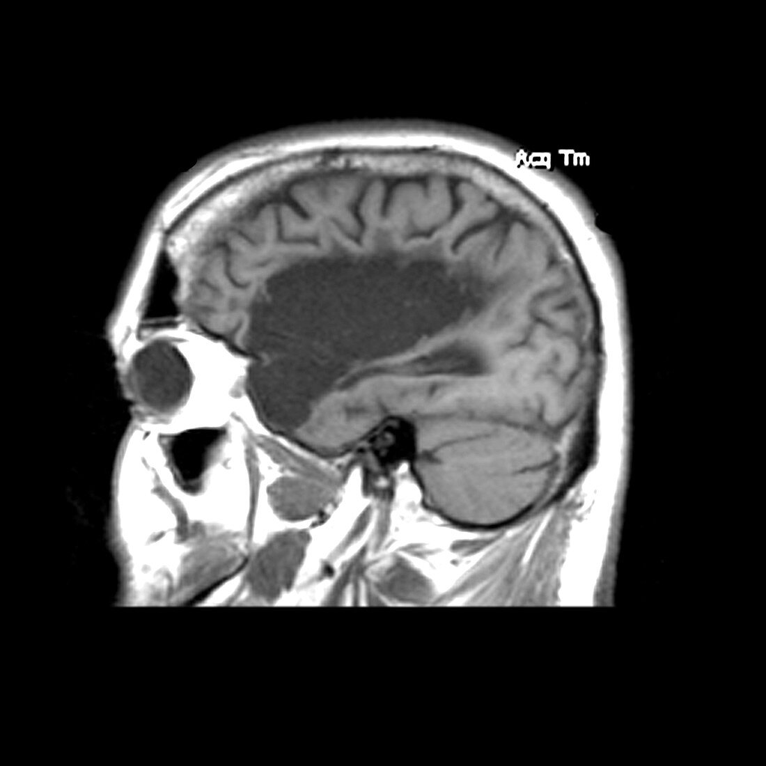 Old Stroke,MRI