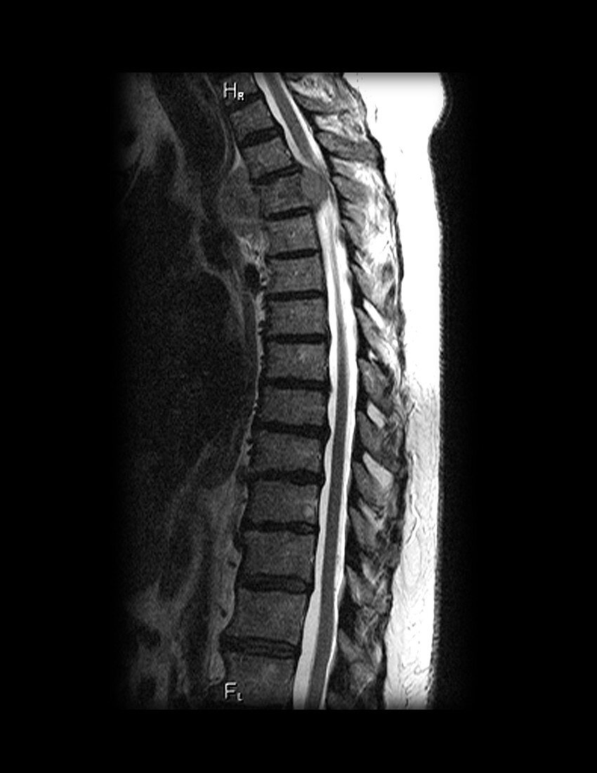 Metastatic Disease to Spine,MRI