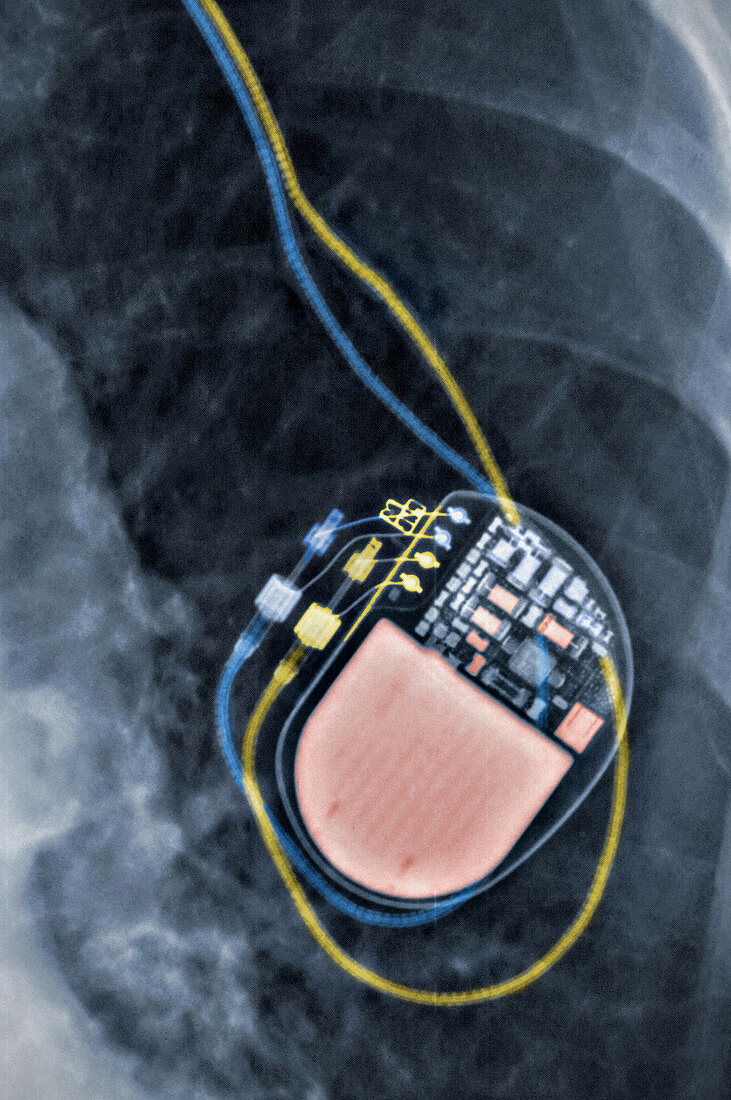 Implantable Defibrillator (Pacemaker)