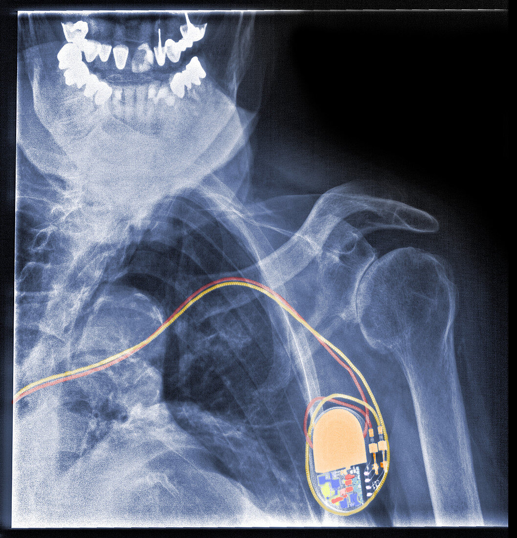 Implantable Defibrillator (Pacemaker)