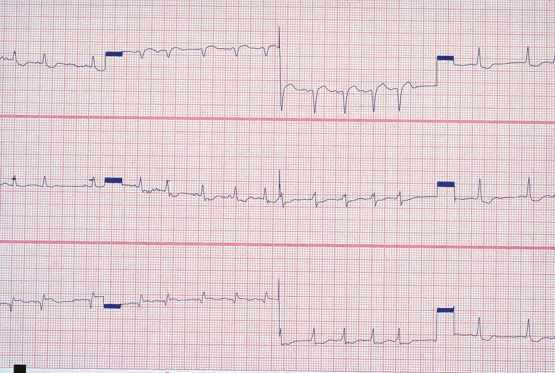 Multifocal Atrial Tachycardia EKG
