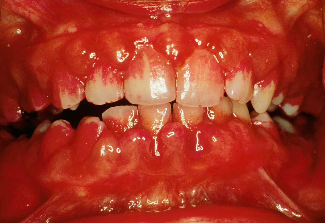 Severe Gingivitis