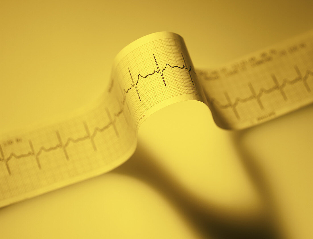 Yellow EKG Cardiac Rhythm Strip
