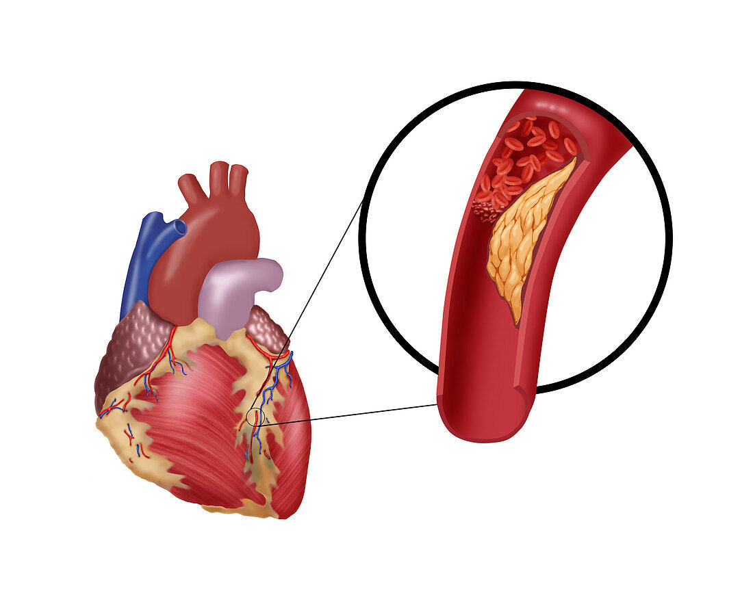 Thrombosis in Coronary Artery